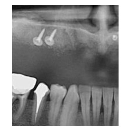 SURUB OSTEOSINTEZA TENDING 1,6x 8mm (set 5 buc)