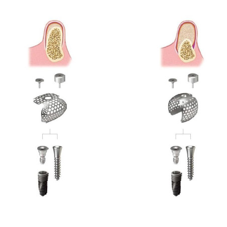 SURUB IMPLANT PRINDERE MEMBRANA TITAN D2.1x11.5mm TS2   SBS2011I