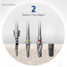 TRUSA CHIRURGICALA COMPLETA OSSTEM 122  KIT  O122TPK