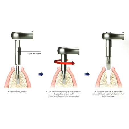 TRUSA EFR KIT COMPLETA EXTRACTIE IMPLANTURI OSSTEM  OSFRFK