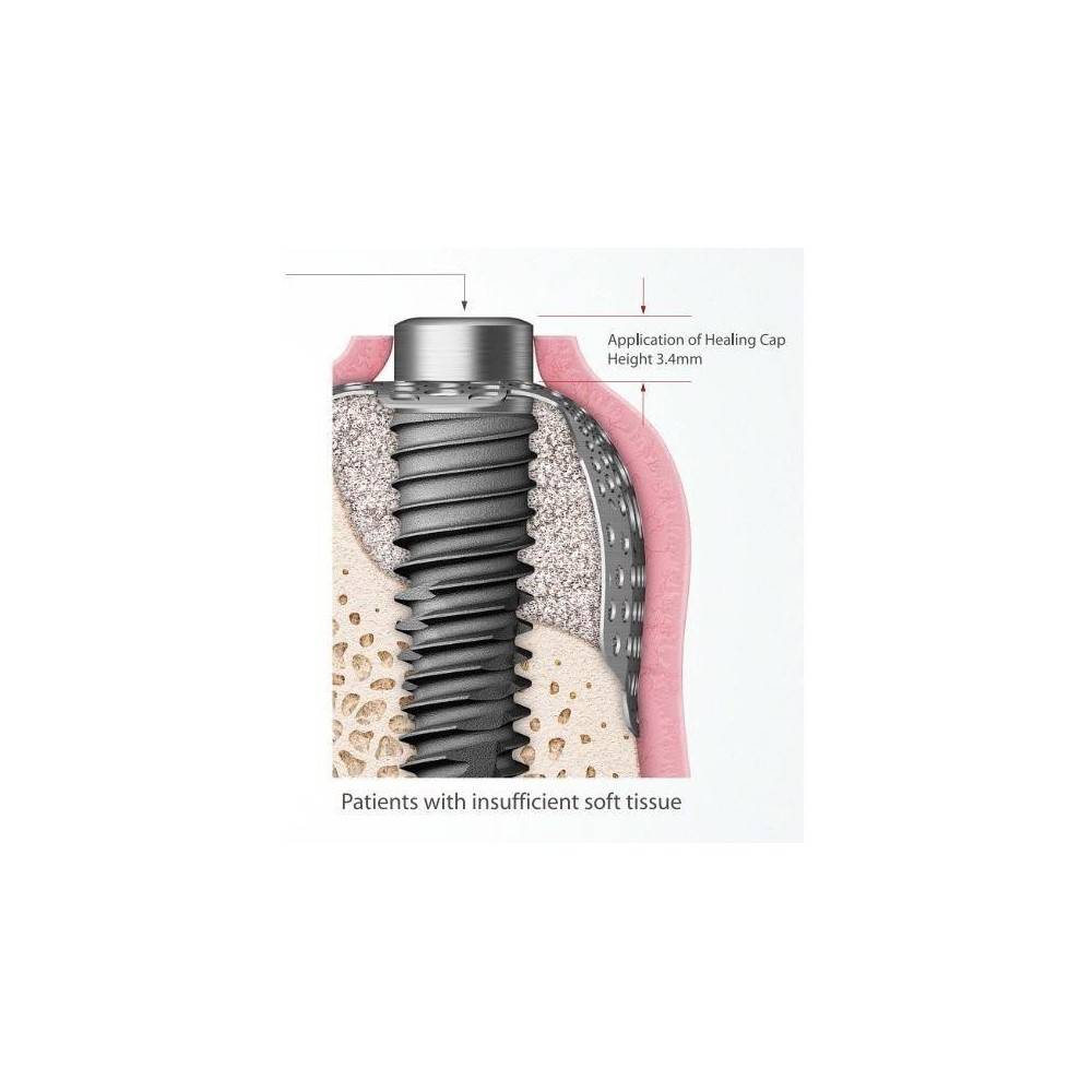 CAPA VINDECARE PRINDERE MEMBRANA TITAN D4mm H3mm V2