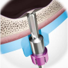 TRUSA SINUS CRESTAL GHIDAT ONE CAS KIT