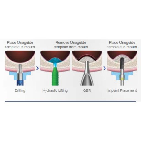 TRUSA SINUS CRESTAL GHIDAT ONE CAS KIT