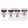 TRUSA SINUS CRESTAL GHIDAT ONE CAS KIT