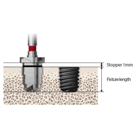 TRUSA CHIRURGICALA IMPLANT SHORT 485 KIT