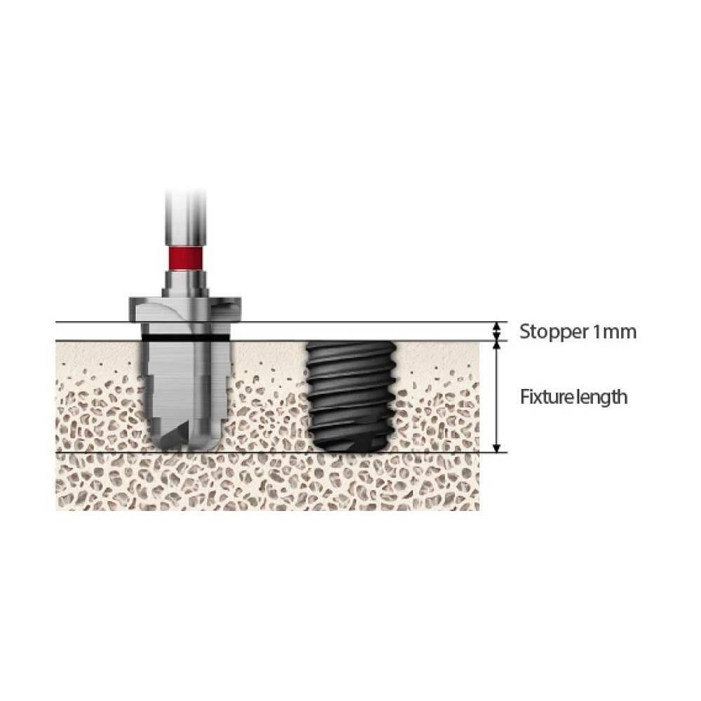 TRUSA CHIRURGICALA IMPLANT SHORT 485 KIT