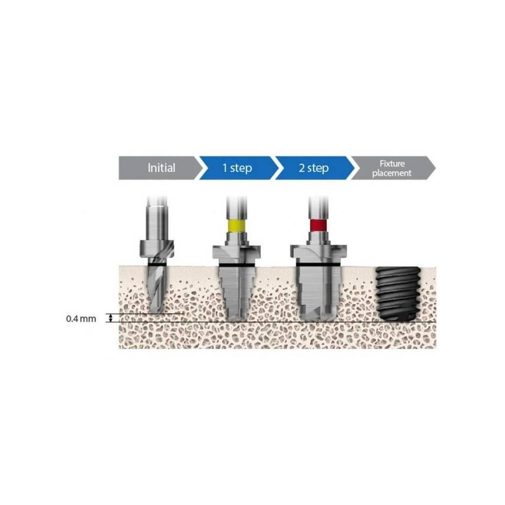 TRUSA CHIRURGICALA IMPLANT SHORT 485 KIT