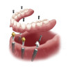 KIT DENTURE 4U ALL ON X