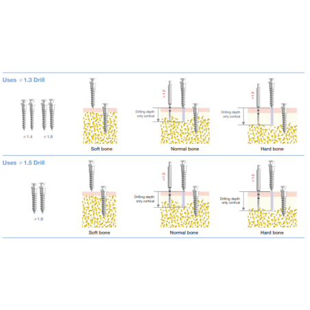 ORTO IMPLANT SH 1.4x6mm  OSSH1406