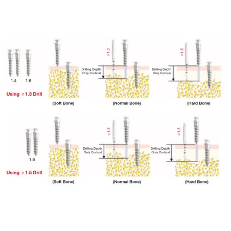 ORTO IMPLANT BH 1.6x8mm  OSBH1608