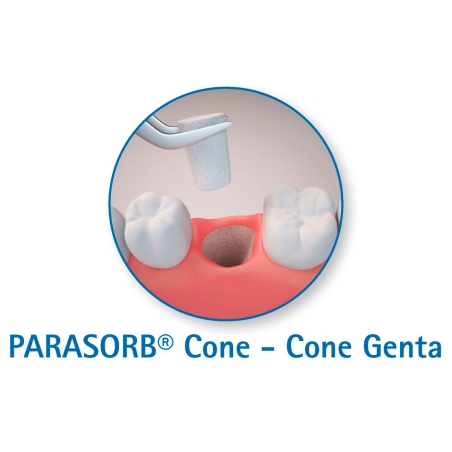 CONURI COLAGEN PARASORB CONE 10 BUC - resorbabil