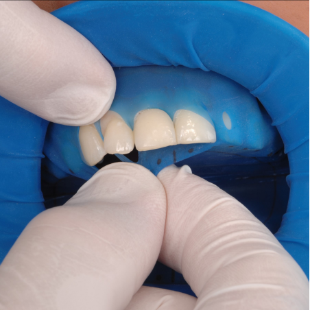 OptraDam Plus Regular