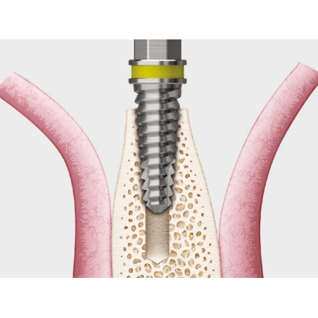 TRUSA SPLIT MANDIBULAR ESSET KIT  HESEK