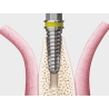 TRUSA SPLIT MANDIBULAR ESSET KIT  HESEK