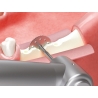 TRUSA SPLIT MANDIBULAR ESSET KIT  HESEK