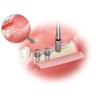 TRUSA SPLIT MANDIBULAR ESSET KIT  HESEK