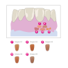 Nexco Paste Gingiva 2.5g G1