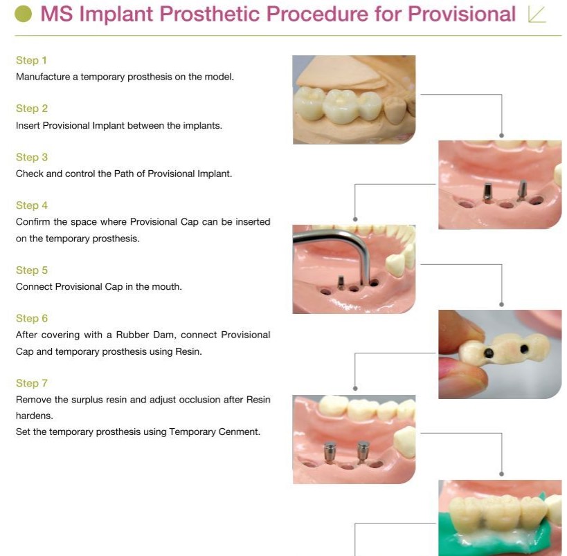 MS IMPLANT PROVIZORIU - Osstem